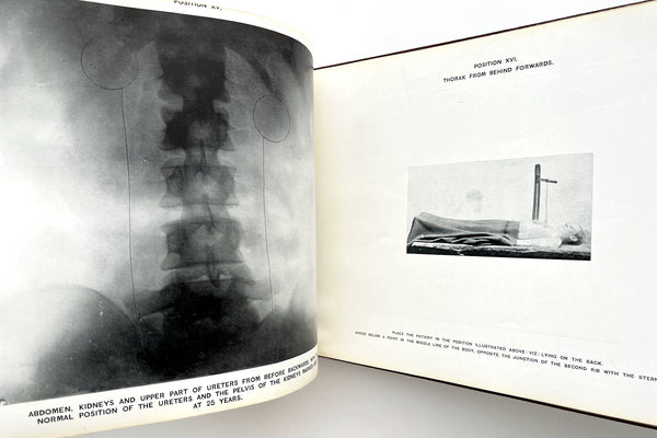 A System of Radiography with an Atlas of the Normal