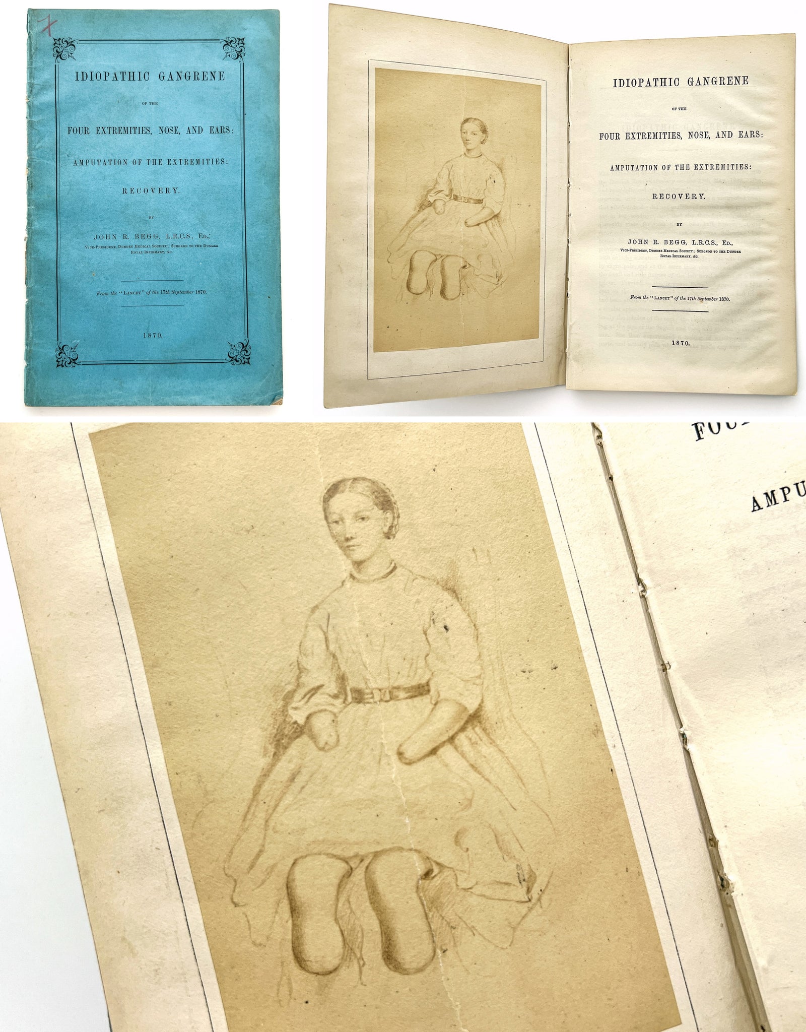 Idiopathic Gangrene of the Four Extremities, Nose and Ears: Amputation of the Extremities: Recovery